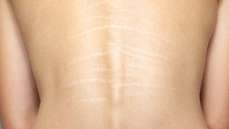 Do Stretch Marks Fade on Their Own?