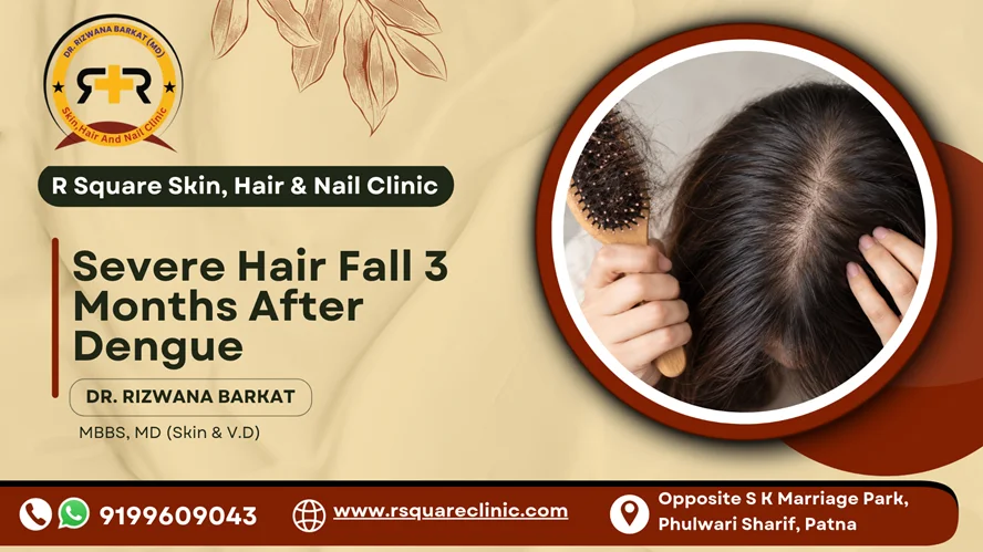 Severe Hair Fall 3 Months After Dengue